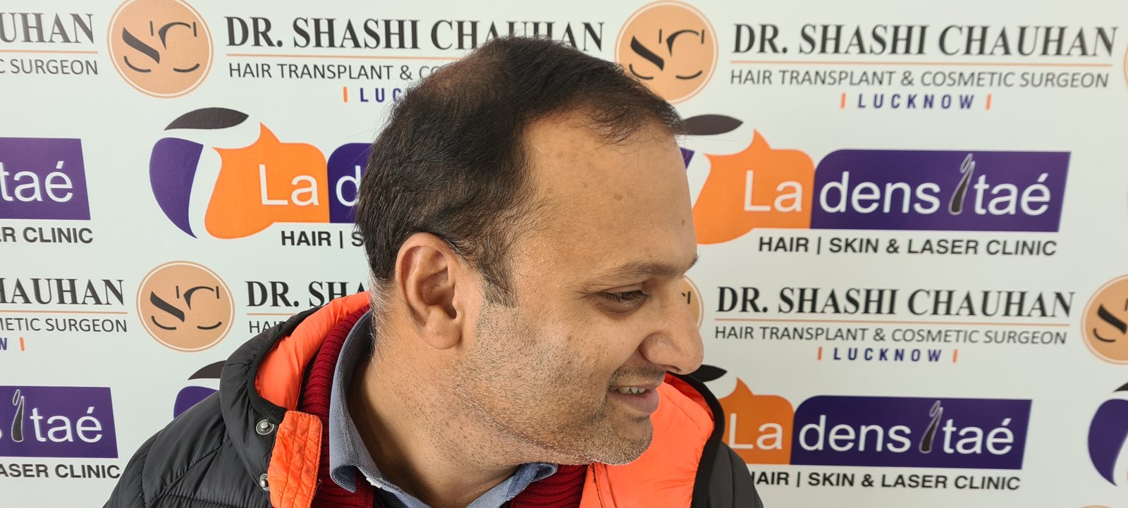 Rahul Agrawal Before Hair Transplant